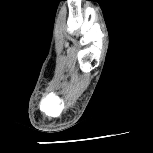 Anterior tibial artery false aneurysm (Radiopaedia 88984-105809 A 213).jpg