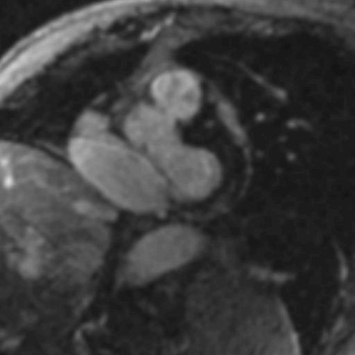 File:Anteroseptal hypokinesia after myocardial infarction (Radiopaedia 15978-15633 I 2).jpg