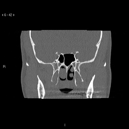 File:Antrochoanal Polyp (Radiopaedia 70510-80631 Coronal bone window 31).jpg