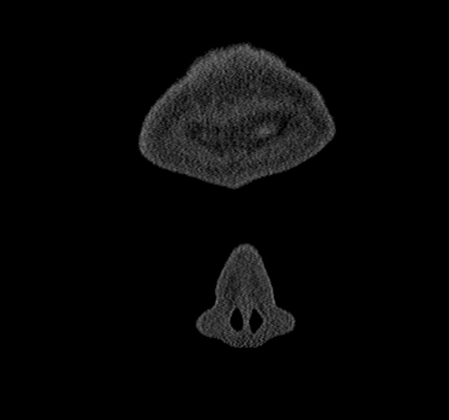 Antrochoanal polyp (Radiopaedia 30002-30554 Coronal bone window 1).jpg