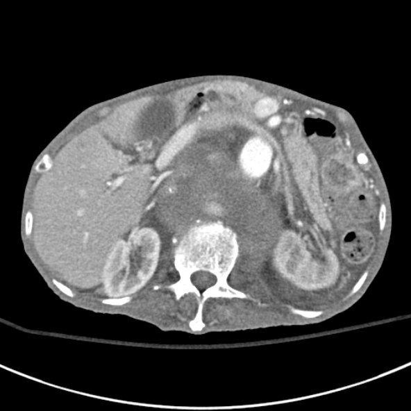 File:Aortic aneurysm with spinal destruction (Radiopaedia 42301-45410 A 31).jpg