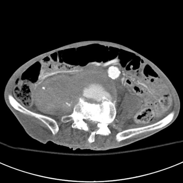 File:Aortic aneurysm with spinal destruction (Radiopaedia 42301-45410 A 67).jpg