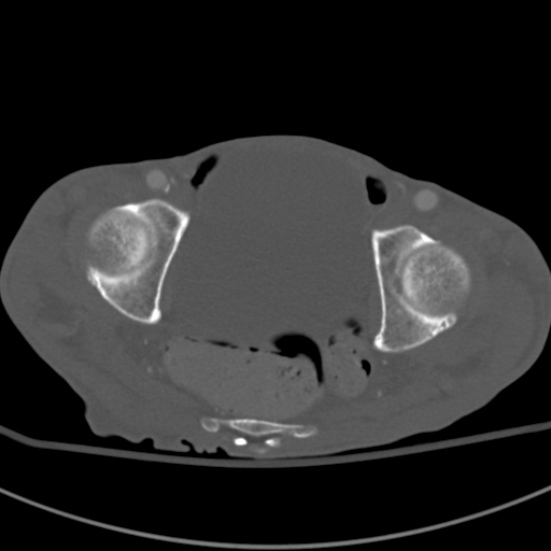 Aortic aneurysm with spinal destruction (Radiopaedia 42301-45410 Axial bone window 101).jpg