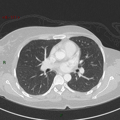 Aortic arch origin of left vertebral artery (Radiopaedia 51520-57286 Axial lung window 111).jpg