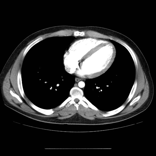 File:Aortic arch stent (Radiopaedia 30030-30595 D 27).jpg