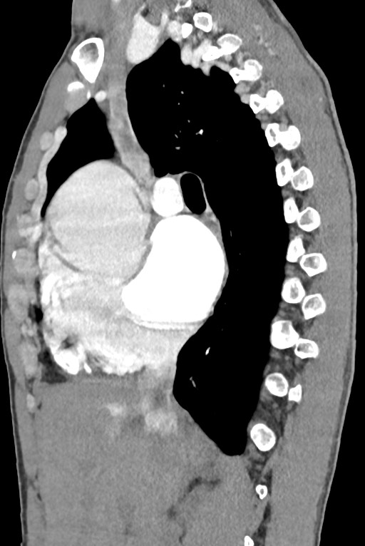 Aortic coarctation with aneurysm (Radiopaedia 74818-85828 B 68).jpg