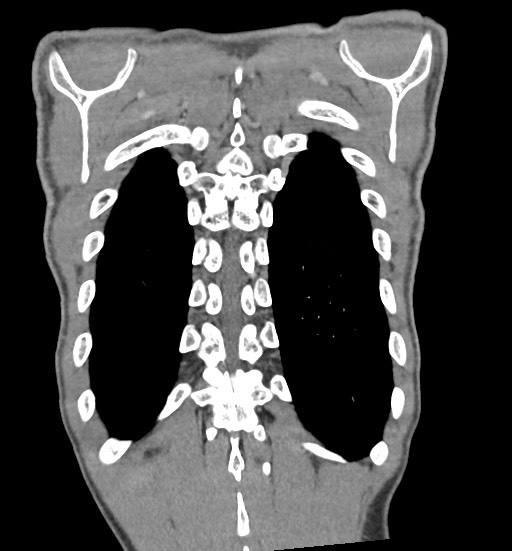 File:Aortic coarctation with aneurysm (Radiopaedia 74818-85828 C 102).jpg