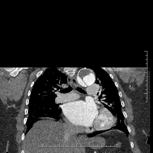 Aortic dissection- Stanford A (Radiopaedia 35729-37268 E 24).jpg