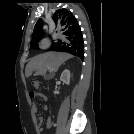 File:Aortic dissection- Stanford A (Radiopaedia 37759-39664 Sagittal C+ delayed 4).png