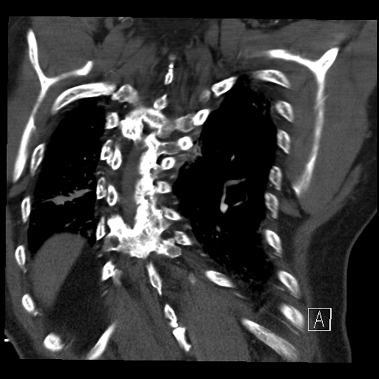 Aortic dissection (CTPA) (Radiopaedia 75506-86750 B 63).jpg