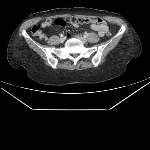 File:Aortic dissection (Radiopaedia 25350-25604 C 79).jpg