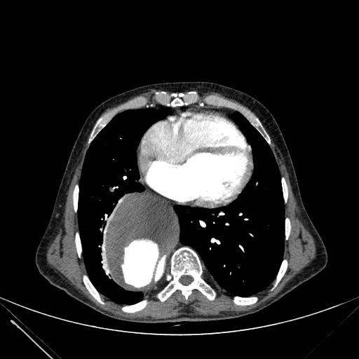 Aortic dissection (Radiopaedia 27466-27665 C+ arterial phase 185).jpg
