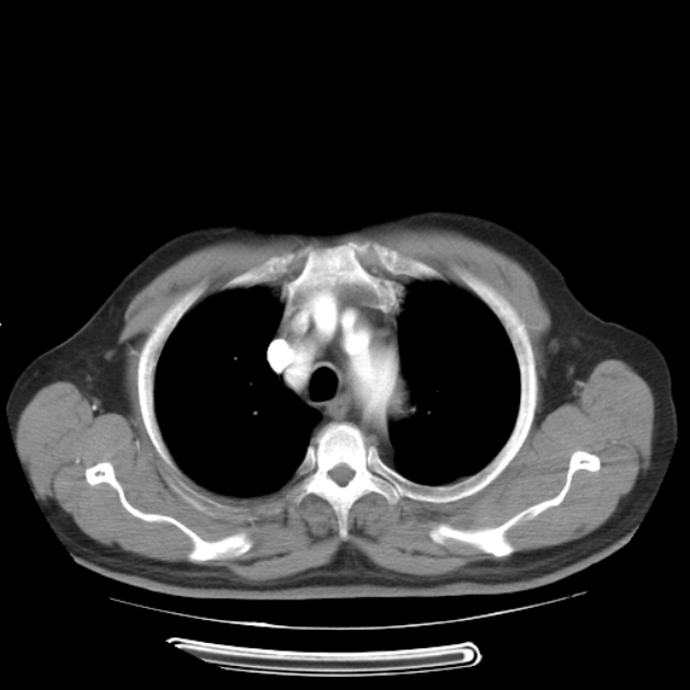 Aortic dissection (Radiopaedia 44411-48061 C 6).jpg