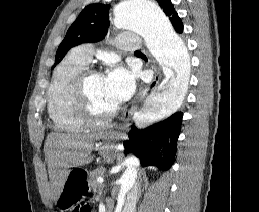 Aortic dissection - Stanford A -DeBakey I (Radiopaedia 28339-28587 C 51).jpg