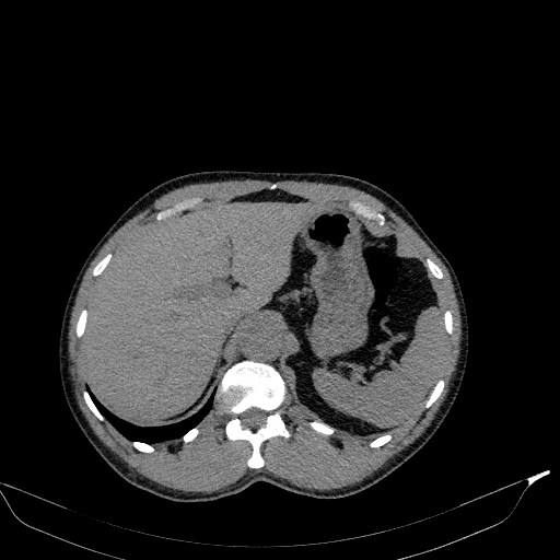 File:Aortic dissection - Stanford type A (Radiopaedia 83418-98500 Axial non-contrast 43).jpg