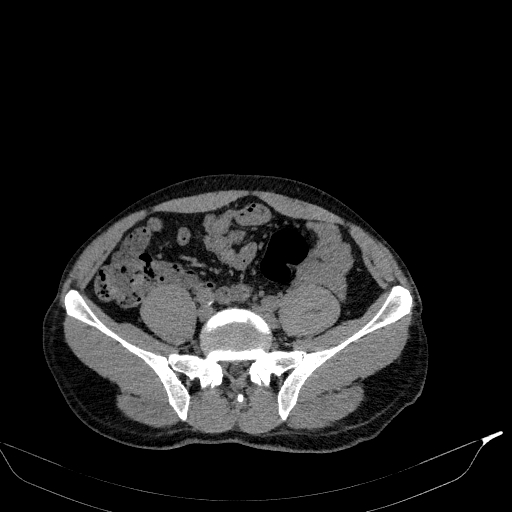File:Aortic dissection - Stanford type A (Radiopaedia 83418-98500 Axial non-contrast 72).jpg