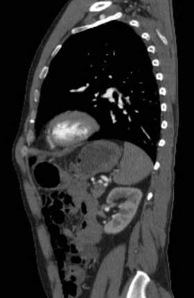 File:Aortic dissection - Stanford type B (Radiopaedia 73648-84437 C 44).jpg