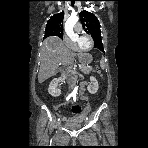 File:Aortic dissection - Stanford type B (Radiopaedia 88281-104910 B 27).jpg