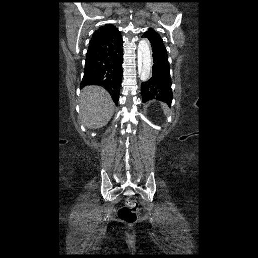 File:Aortic dissection - Stanford type B (Radiopaedia 88281-104910 B 72).jpg