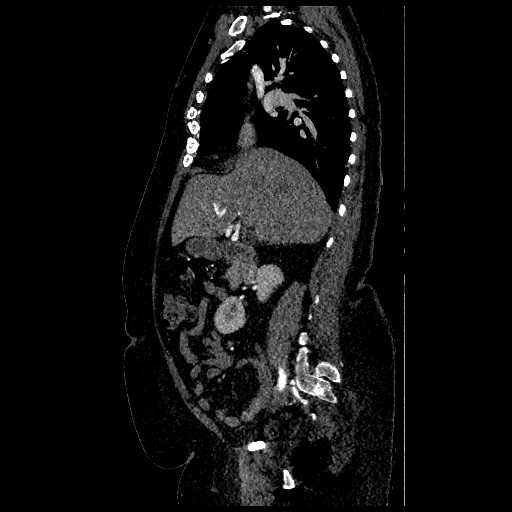 File:Aortic dissection - Stanford type B (Radiopaedia 88281-104910 C 27).jpg
