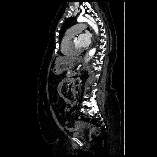 File:Aortic dissection - Stanford type B (Radiopaedia 88281-104910 C 47).jpg