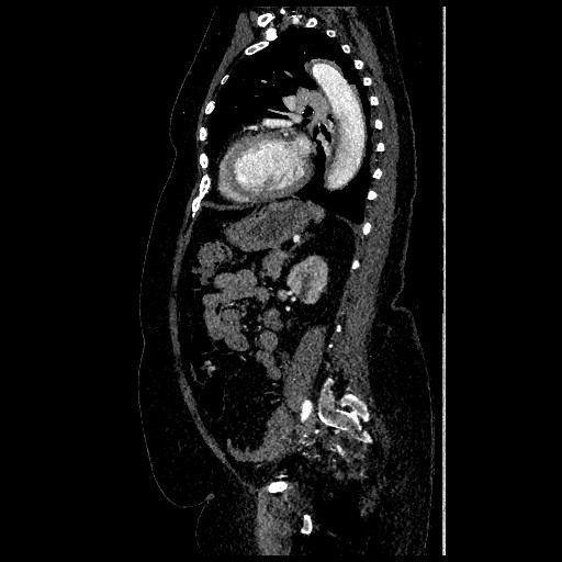 File:Aortic dissection - Stanford type B (Radiopaedia 88281-104910 C 58).jpg