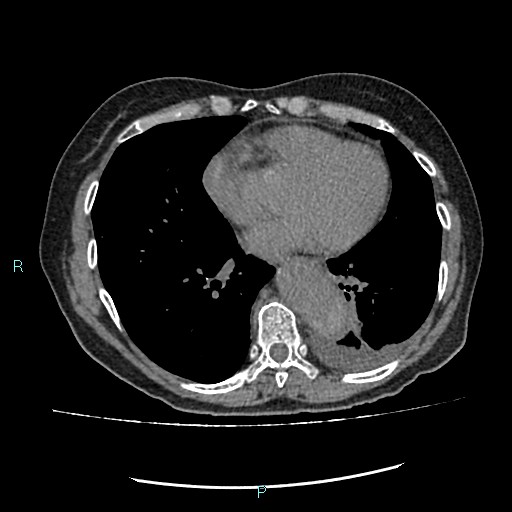 File:Aortic dissection extended to lusory artery (Radiopaedia 43686-47136 Axial non-contrast 19).jpg