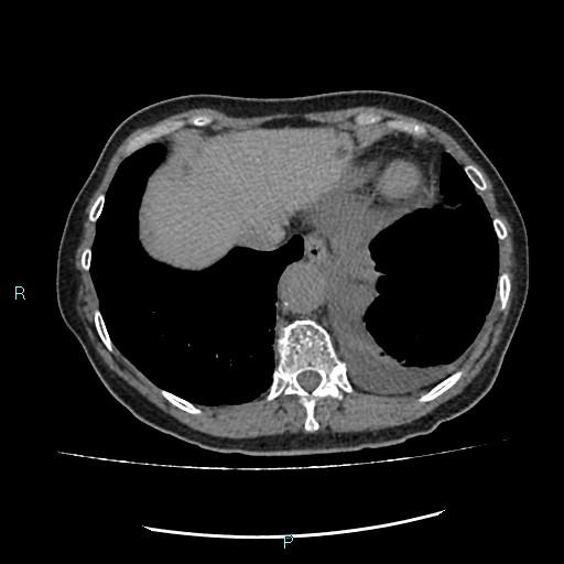 File:Aortic dissection extended to lusory artery (Radiopaedia 43686-47136 Axial non-contrast 24).jpg