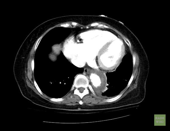 File:Aortic intramural hematoma (Radiopaedia 11198-11562 E 1).jpg