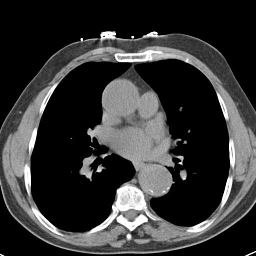 Aortic intramural hematoma (Radiopaedia 31139-31838 Axial non-contrast 30).jpg