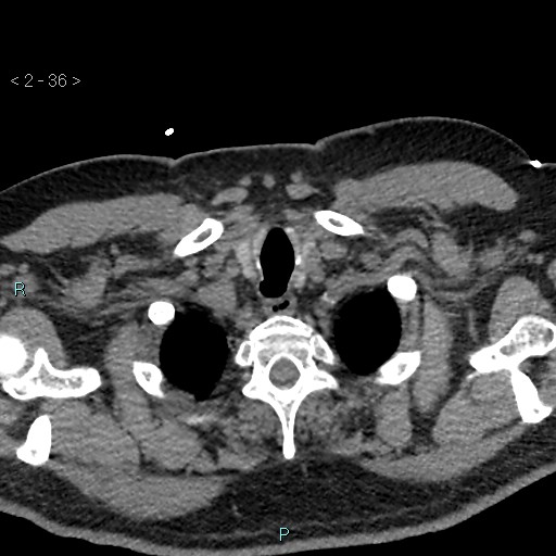 Aortic intramural hematoma (Radiopaedia 48463-53380 Axial non-contrast 16).jpg