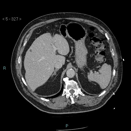 File:Aortic intramural hematoma (Radiopaedia 48463-53380 C 147).jpg