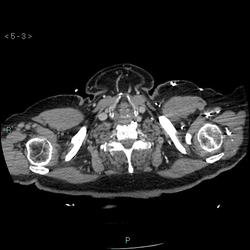 Aortic intramural hematoma (Radiopaedia 48463-53380 C 3).jpg