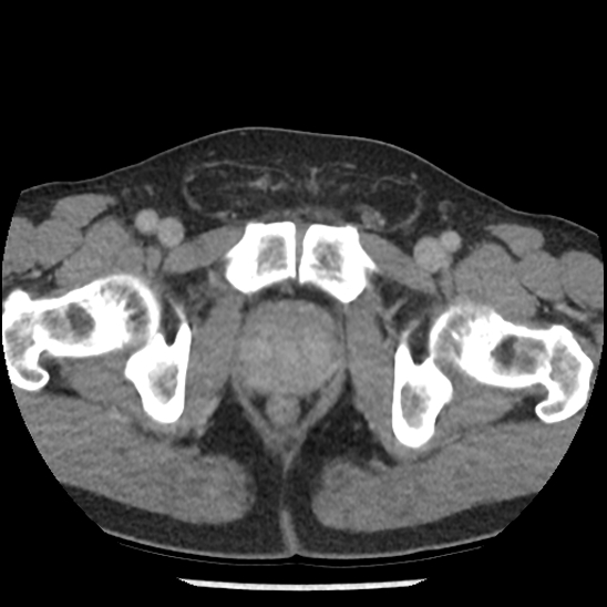Aortic intramural hematoma (type B) (Radiopaedia 79323-92387 Axial C+ delayed 115).jpg