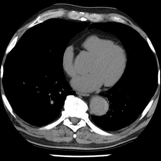 File:Aortic intramural hematoma (type B) (Radiopaedia 79323-92387 Axial non-contrast 34).jpg