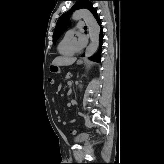 Aortic intramural hematoma (type B) (Radiopaedia 79323-92387 G 31).jpg