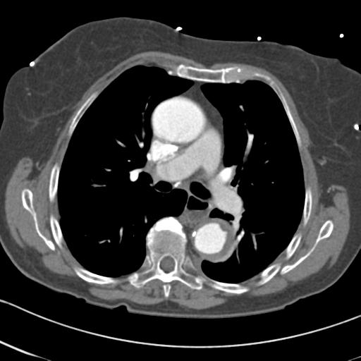 Aortic intramural hematoma from penetrating atherosclerotic ulcer (Radiopaedia 31137-31836 A 35).jpg