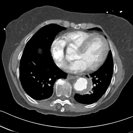 Aortic intramural hematoma from penetrating atherosclerotic ulcer (Radiopaedia 31137-31836 A 55).jpg