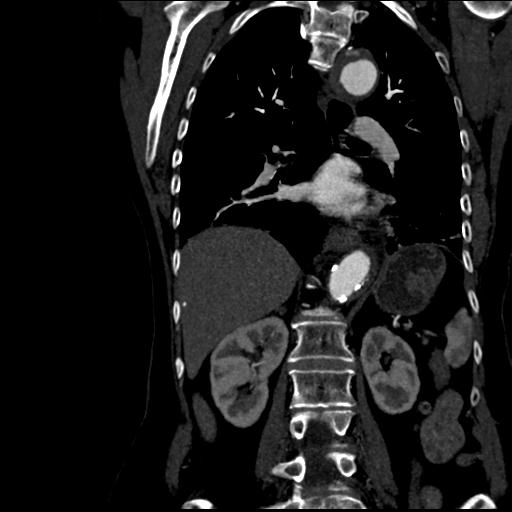 File:Aortic intramural hematoma from penetrating atherosclerotic ulcer (Radiopaedia 31137-31836 C 41).jpg