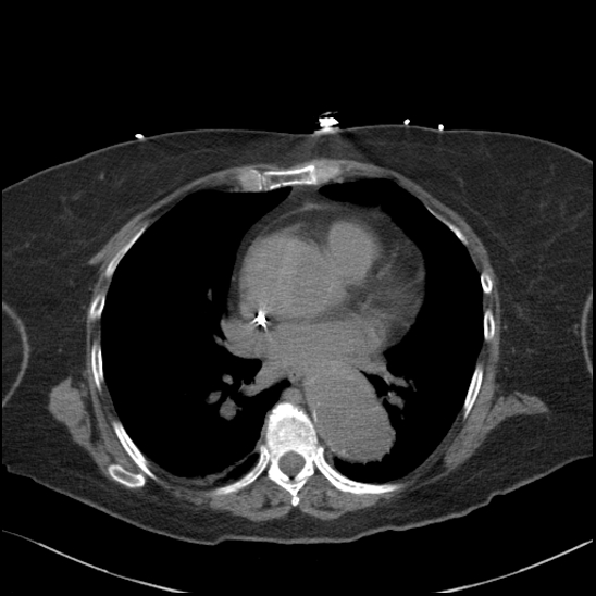 File:Aortic intramural hematoma with dissection and intramural blood pool (Radiopaedia 77373-89491 Axial non-contrast 54).jpg