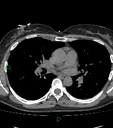 Aortic valve endocarditis (Radiopaedia 87209-103485 Axial non-contrast 51).jpg