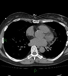 Aortic valve endocarditis (Radiopaedia 87209-103485 Axial non-contrast 61).jpg