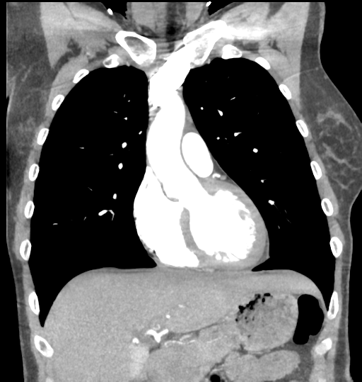 Aortic valve non-coronary cusp thrombus (Radiopaedia 55661-62189 C 29).png