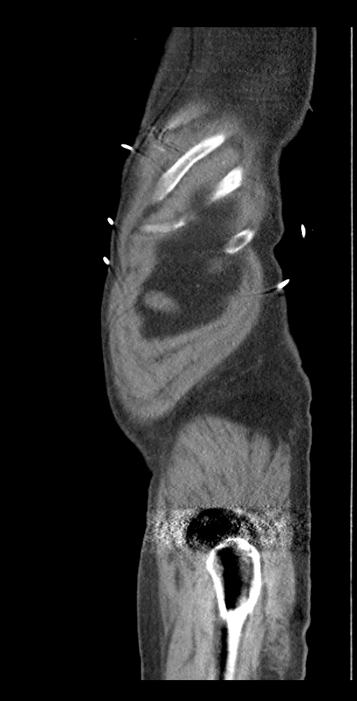 Aortoduodenal fistula (Radiopaedia 75286-86415 Sagittal C+ delayed 2).jpg