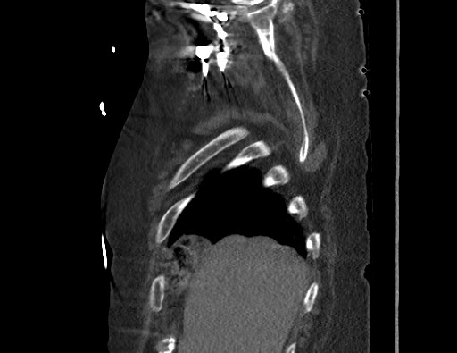 Aortoesophageal fistula with endovascular repair (Radiopaedia 73781-84592 Sagittal C+ CTPA 14).jpg