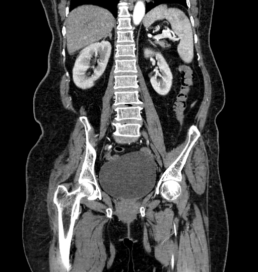 Aortoiliac occlusive disease (Radiopaedia 52352-58248 B 41).jpg