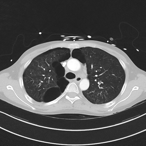 Apical bullous disease in a heavy smoker (Radiopaedia 33067-34092 Axial lung window 22).png