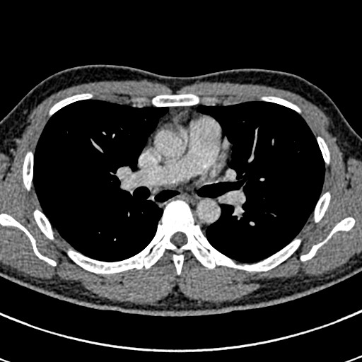Apical lung mass mimic - neurogenic tumor (Radiopaedia 59918-67521 A 37).jpg