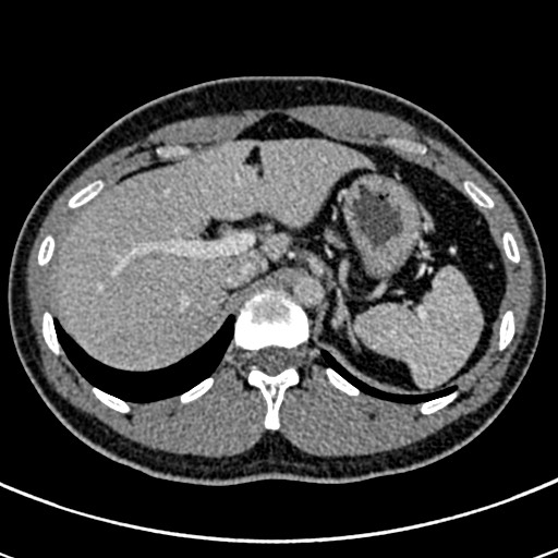 Apical lung mass mimic - neurogenic tumor (Radiopaedia 59918-67521 A 81).jpg