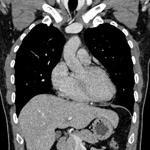 File:Apical lung mass mimic - neurogenic tumor (Radiopaedia 59918-67521 B 51).jpg